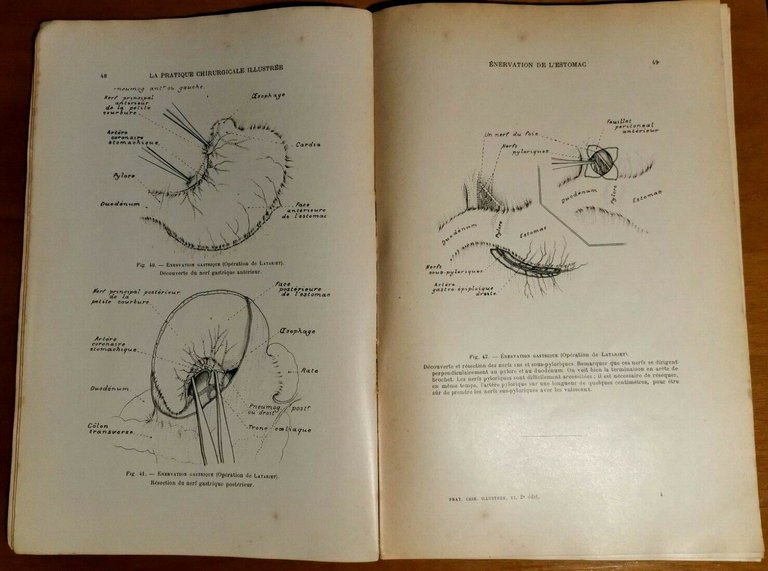 LA PRATIQUE CHIRURGICALE ILLUSTREE di Victor Pauchet 1930 cancro utero …