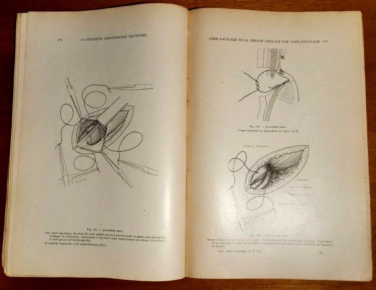 LA PRATIQUE CHIRURGICALE ILLUSTREE di Victor Pauchet 1930 cancro utero …