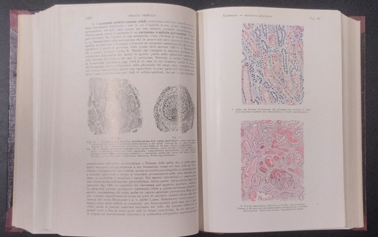 TRATTATO DI ANATOMIA PATOLOGICA SPECIALE 3 Volumi Kaufmann 1925 Vallardi …