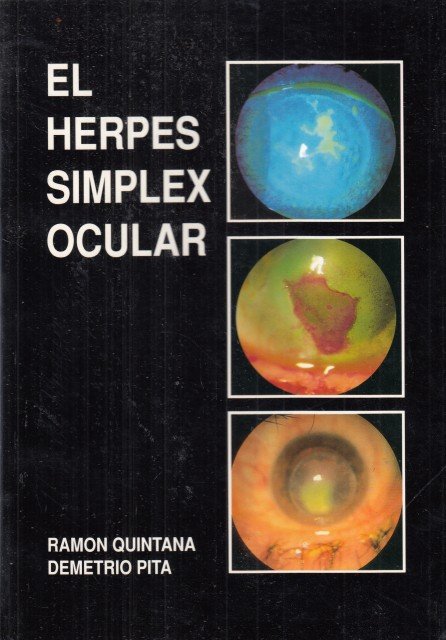 EL HERPES SIMPLEX OCULAR | Immagine principale