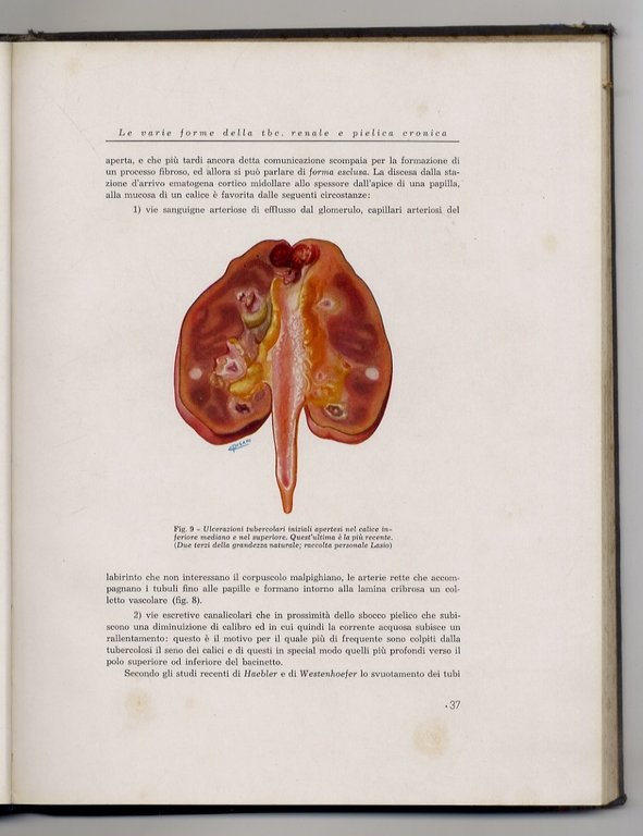 La tubercolosi renale chirurgica.
