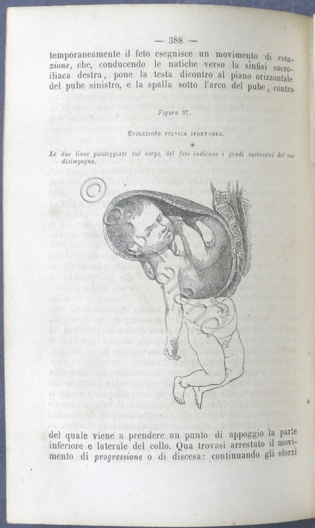V. Balocchi - Manuale completo di ostetricia ad uso delle …