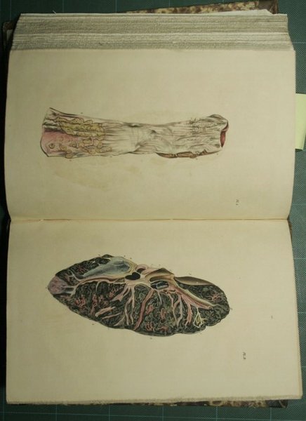 Traitè de l'auscultation mediate et des maladies des poumons et …