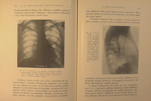 La tubercolosi della regione ilo-polmonare