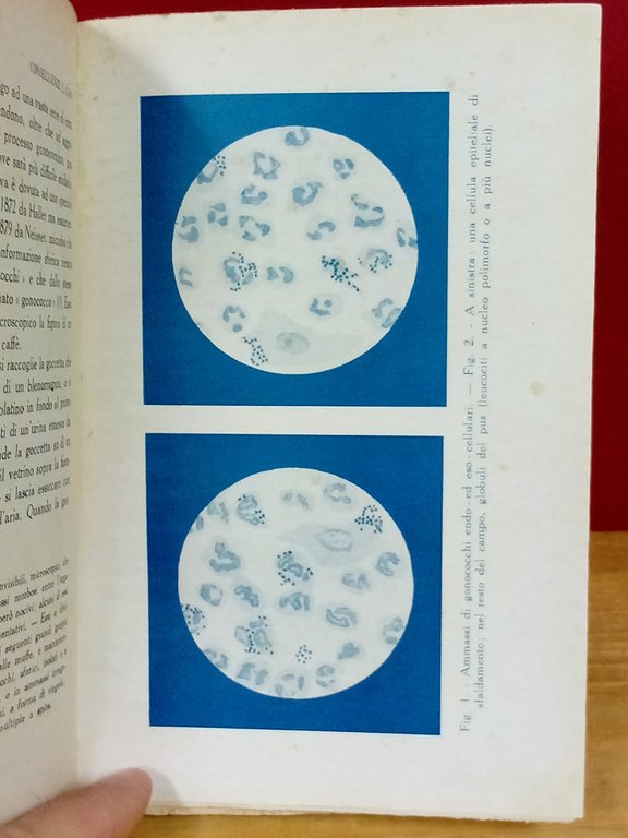 Il pericolo Neisser. Conseguenze e cura della blenorragia. | Immagine Gallery 2