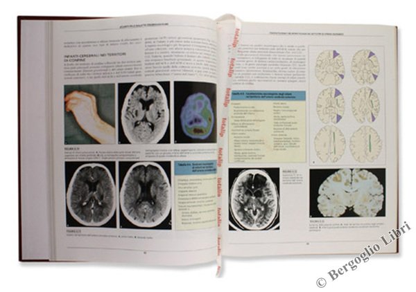 ATLANTE DELLE MALATTIE CEREBROVASCOLARI.