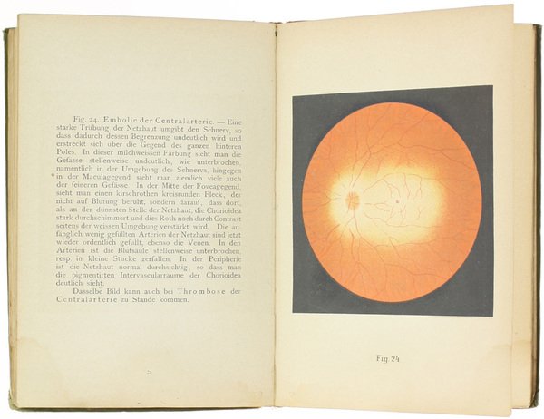 ATLAS UN GRUNDRISS DER OPHTHALMOSKOPIE UN OPHTHALMOSKOPISCHEN DIAGNOSTIK.