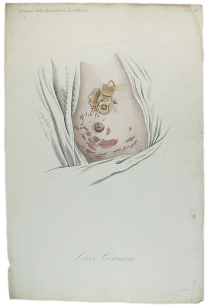 Tavola originale: LEUCE COMUNE., N. 38 (da: CLINICA DEL PARIGINO …