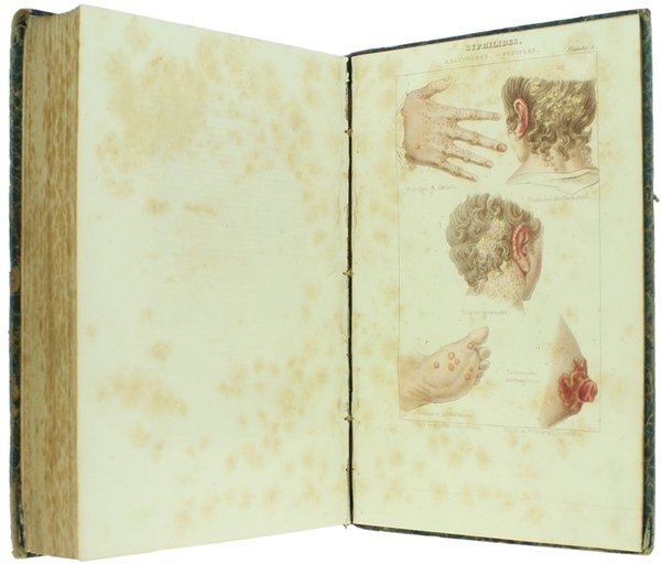 TRATTATO DELLE MALATTIE SIFILITICHE DELLE AFFEZIONI DELLA PELLE E DELLE …