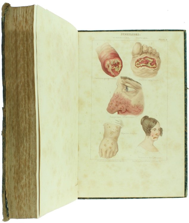 TRATTATO DELLE MALATTIE SIFILITICHE DELLE AFFEZIONI DELLA PELLE E DELLE …