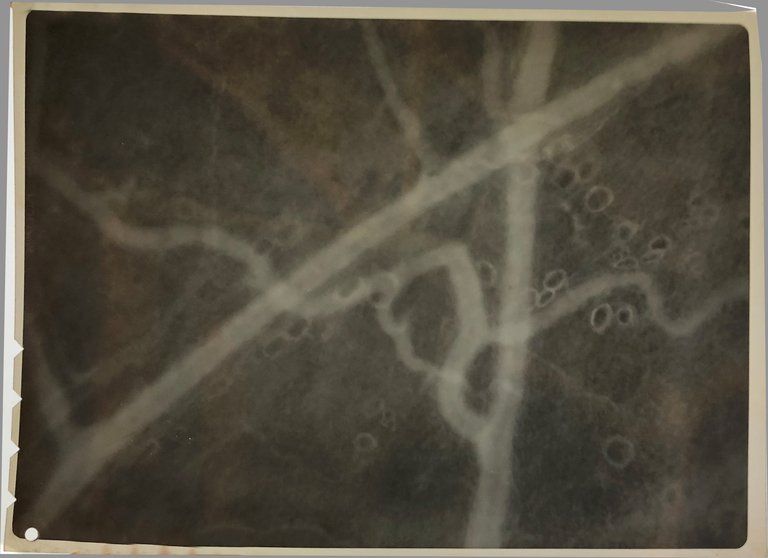 Ensemble de six négatifs photographiques visualisant des hémorragies au microscope