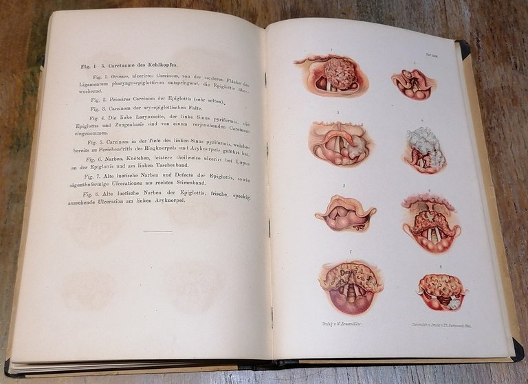 Klinischer Atlas der Laryngologie nebst Anleitung zur Diagnose und Therapie …
